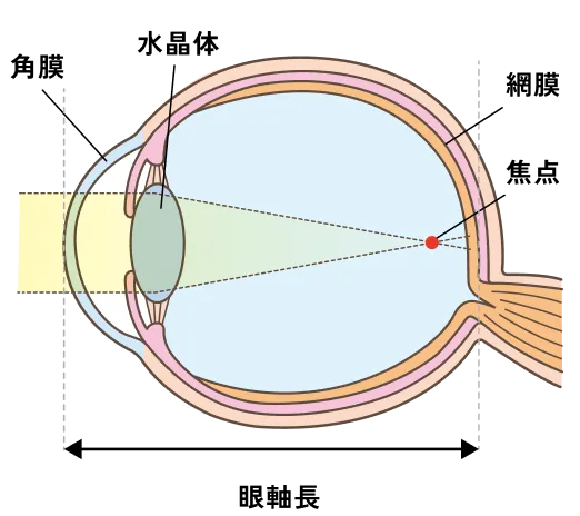 図：近視の仕組み