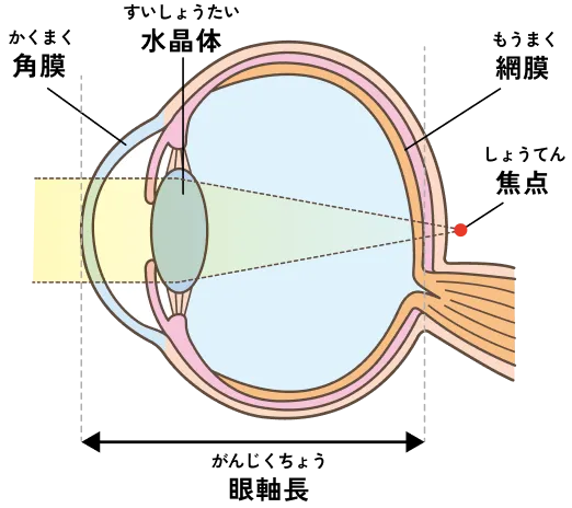 図：遠視の仕組み