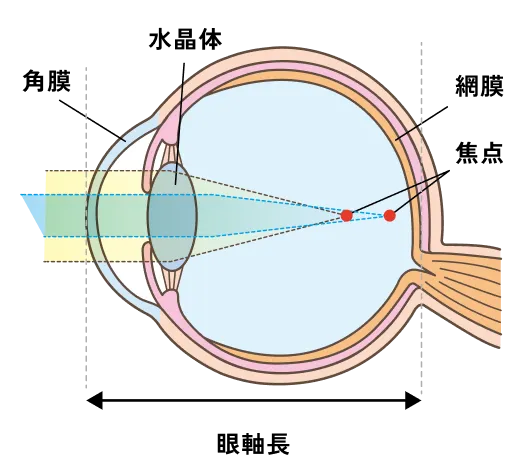 図：乱視の仕組み