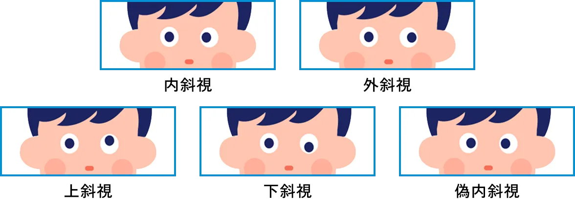 図：斜視の種類