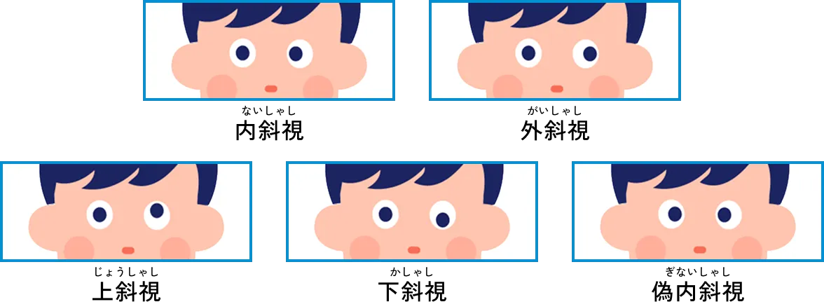 図：斜視の種類