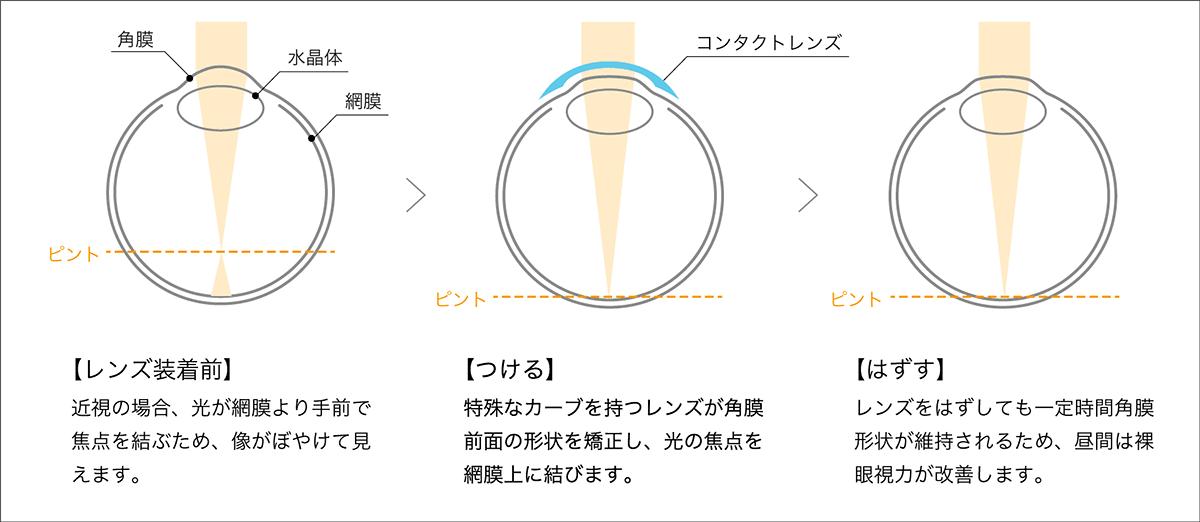 【レンズ装着前】近視の場合、光が網膜より手前で焦点を結ぶため、像がぼやけて見えます。【つける】特殊なカーブを持つレンズが角膜前面の形状を矯正し、光の焦点を網膜上に結びます。【はずす】レンズをはずしても一定時間角膜形状が維持されるため、昼間は裸眼視力が改善します。